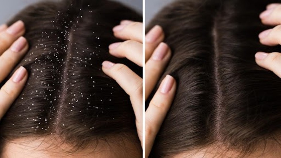 How To Use Coconut Oil For Dandruff?